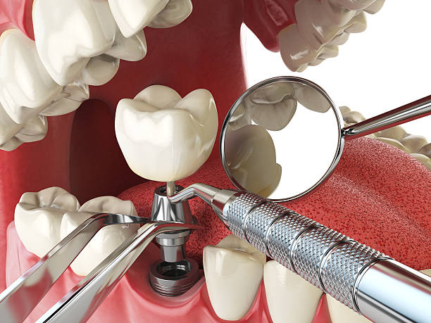Best Emergency Wisdom Teeth Removal in Bennett, CO
